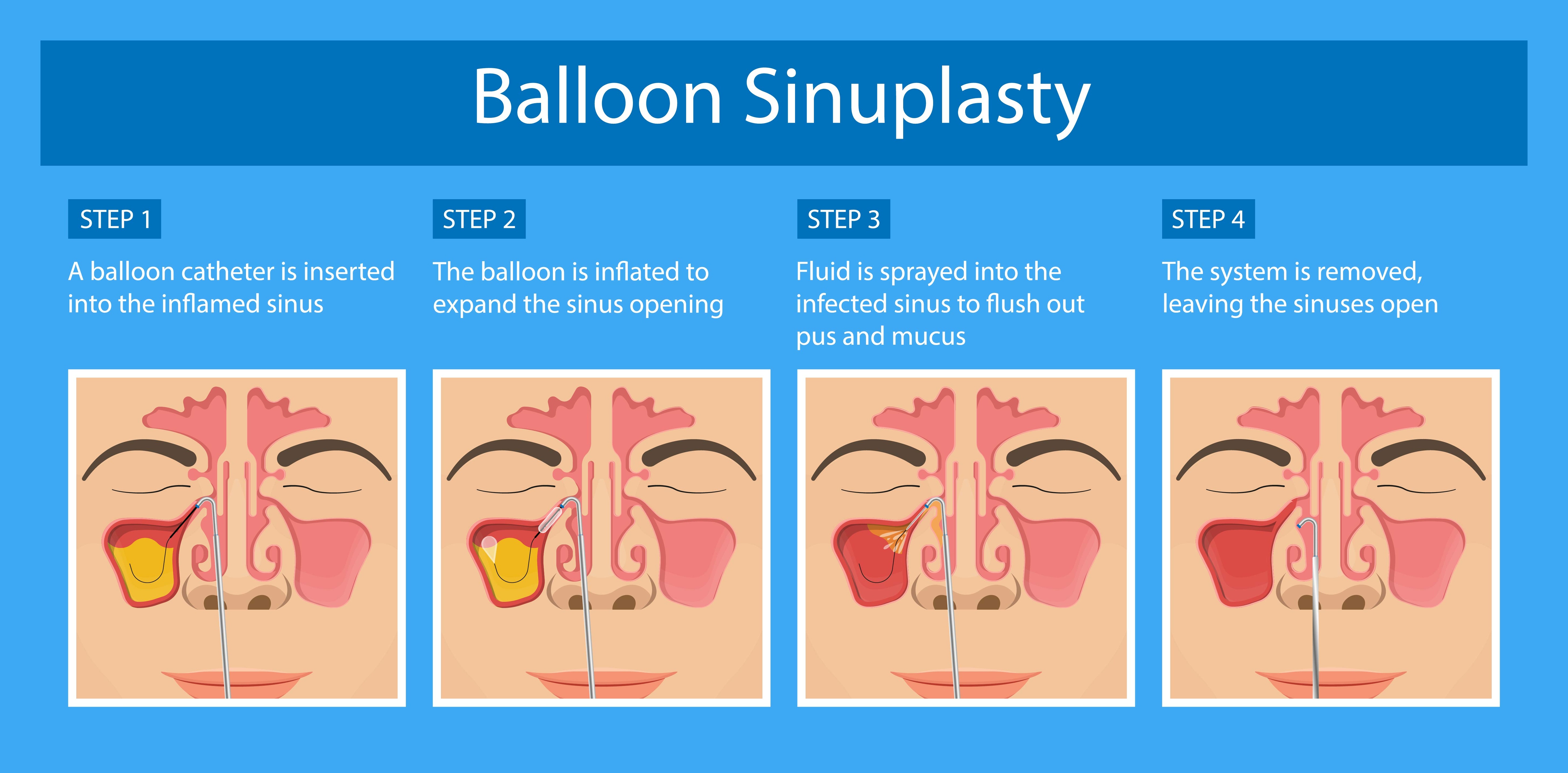balloon sinuplasty